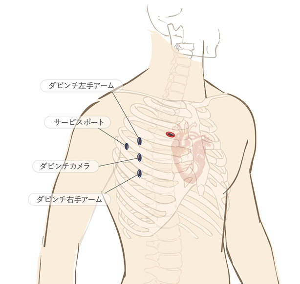 4つの “キーホール(鍵穴)”で術野が広く、精密なオペを実践