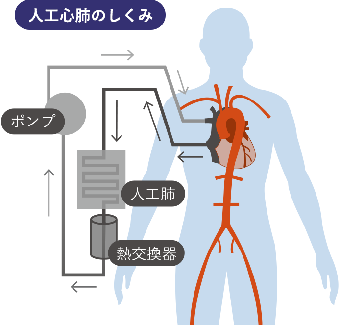 オフポンプ手術