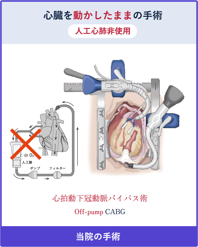 心臓を動かしたままの手術 人工心肺非使用