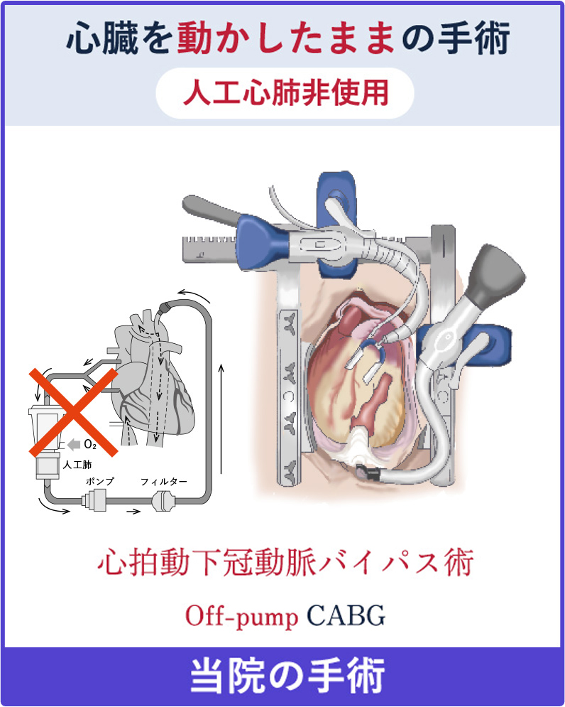 心臓を動かしたままの手術 人工心肺非使用