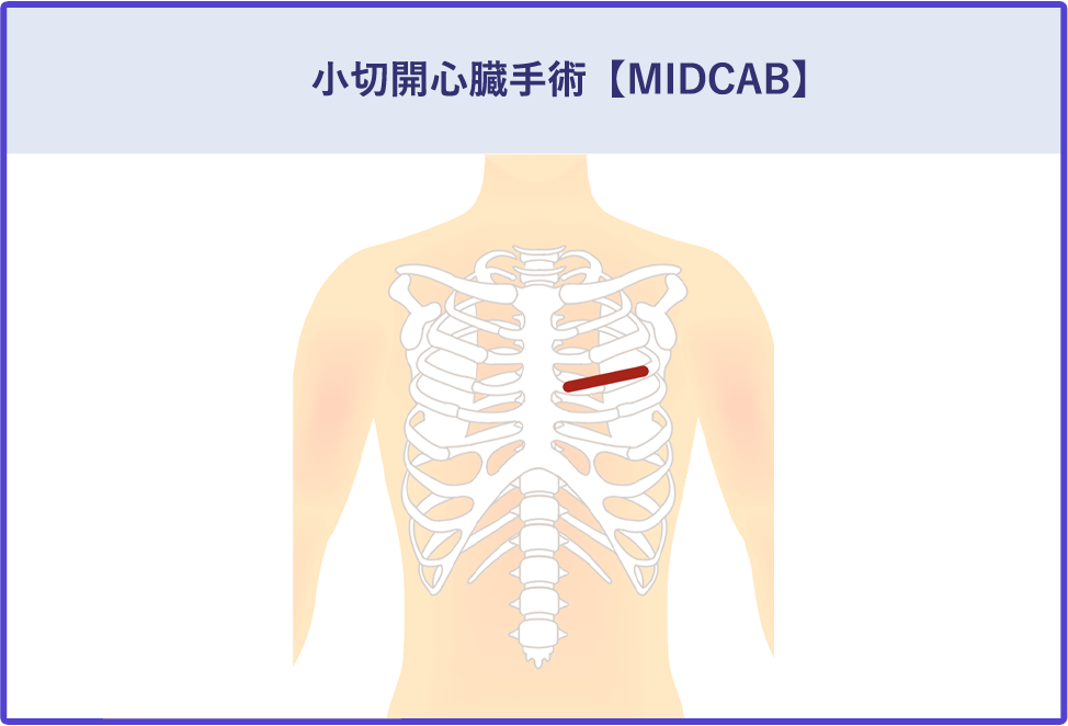 小切開心臓手術【MIDCAB】