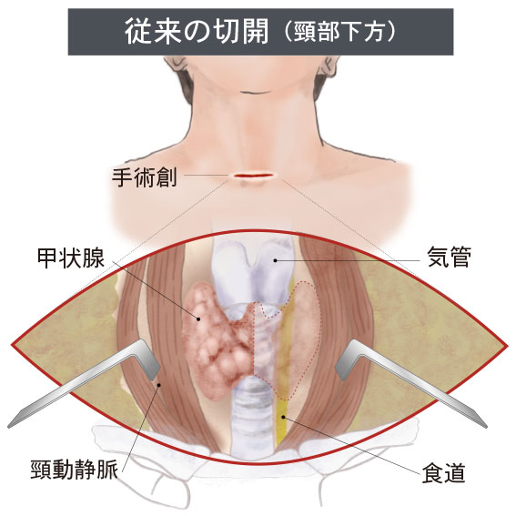 通常手術（頚部切開）