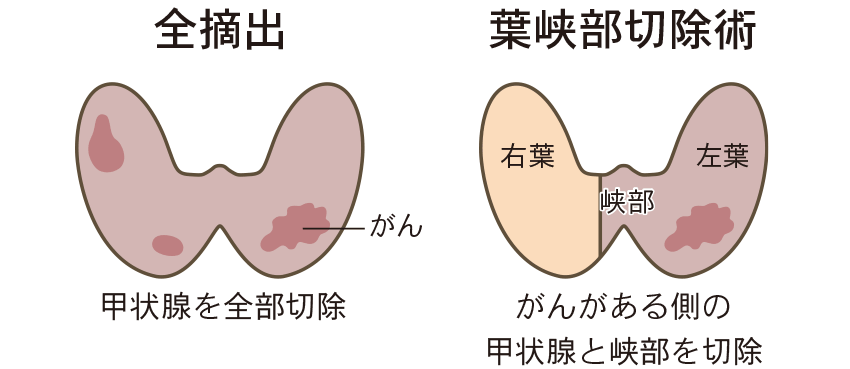 手術アプローチ