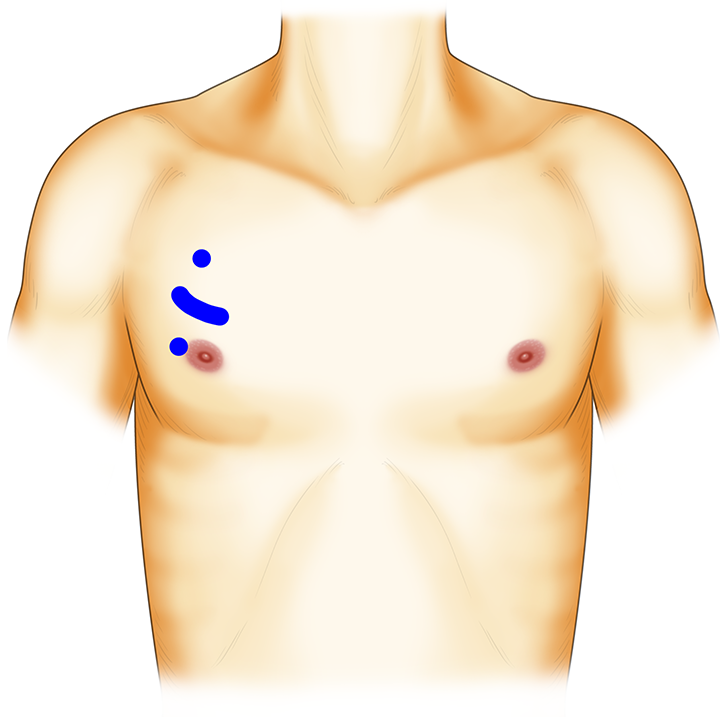 大動脈弁置換術