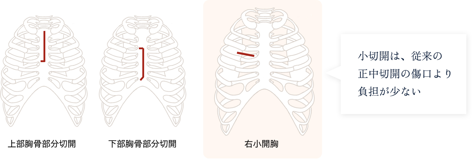 低侵襲性