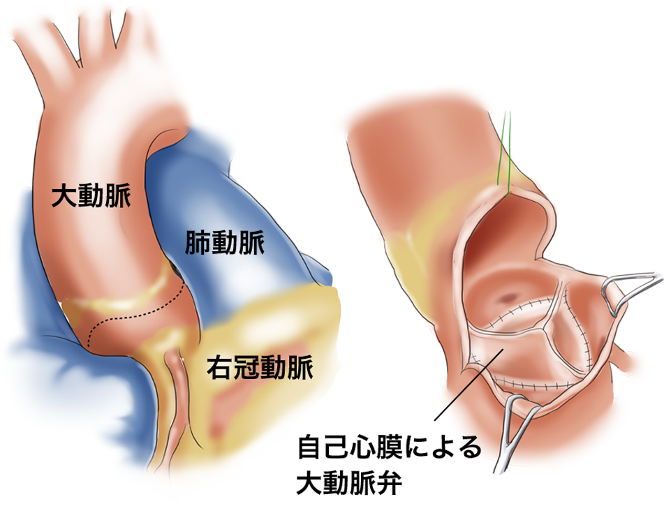 自己心膜弁を用いた大動脈弁形成術